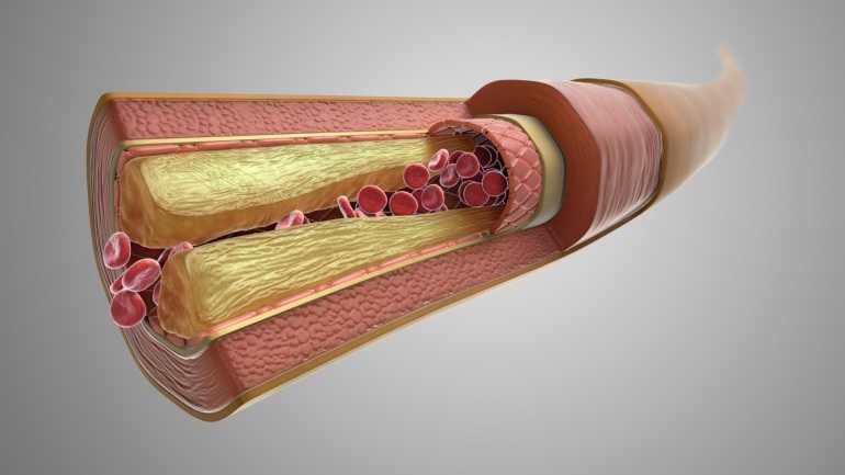 Artery with cutaway section to reveal deposits of plague narrowing the passage for blood flow, شرايين، قلب، تصلب الشرايين، تضيق الشرايين، سكتة دماغية، كوليسترول، كولسترول، دهون، أوعية دموية illustrating the condition atherosclerosis.