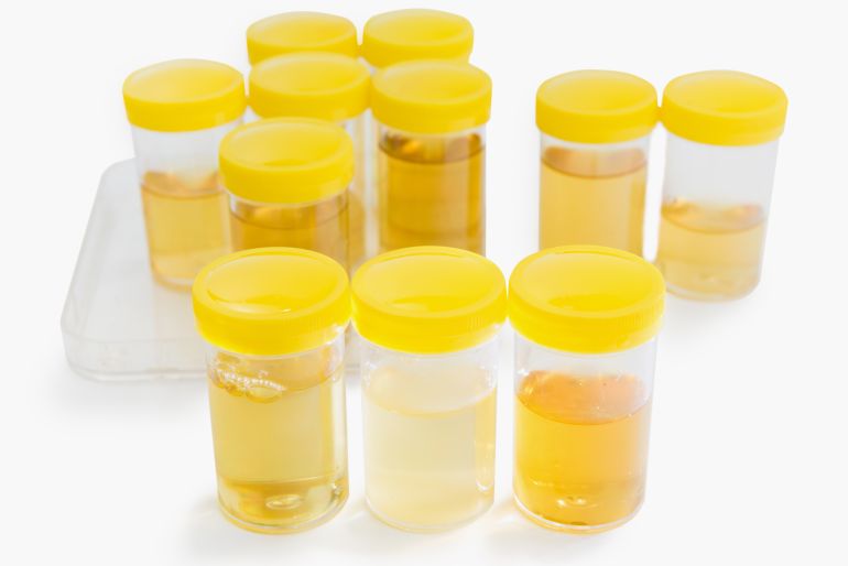 Urine Sample bottle three samples of urine with different colored , isolated on white background, shallow depth of field; Shutterstock ID 1011939436; purchase_order: AJA; job: ; client: ; other: