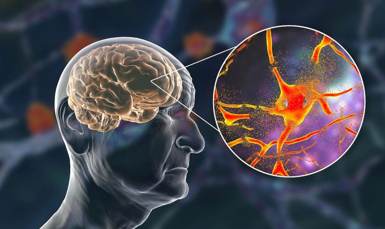 دراسة طبية تكشف عن مؤشر بيولوجي لتسارع شيخوخة الدماغ
