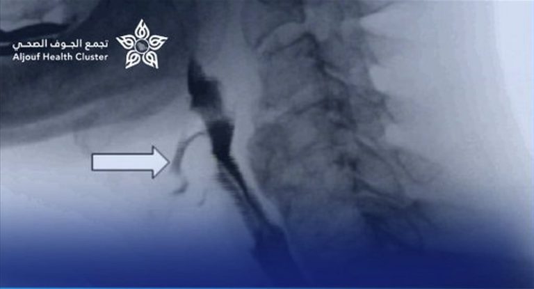 نجاح توسعة مريء لطفل بالمنظار دون تدخل جراحي في «تخصصي الجوف»