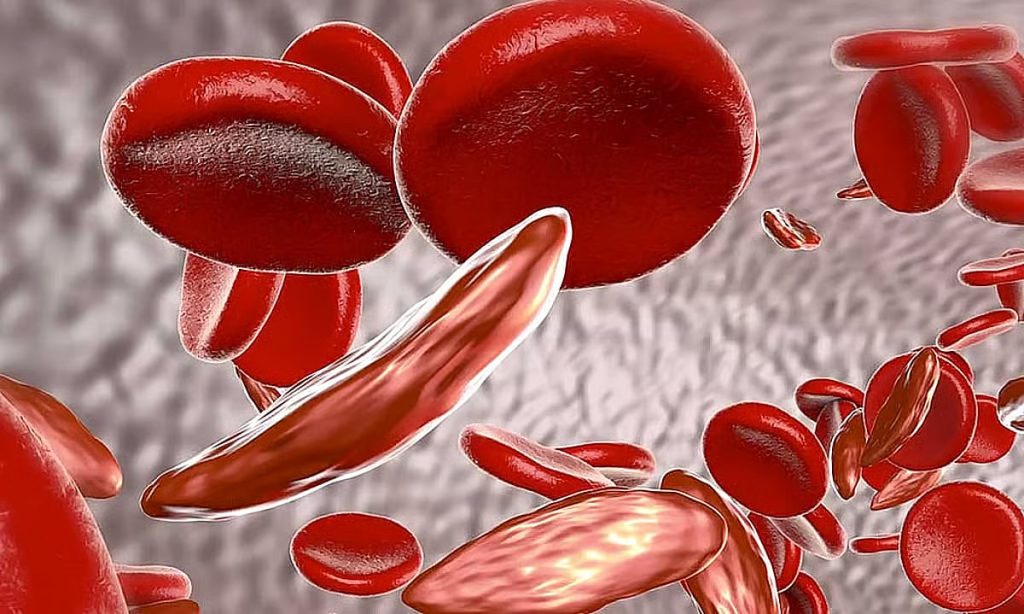 فهد الطبية توضّح أعراض فقر الدم الناتج عن نقص الحديد وعلاجه