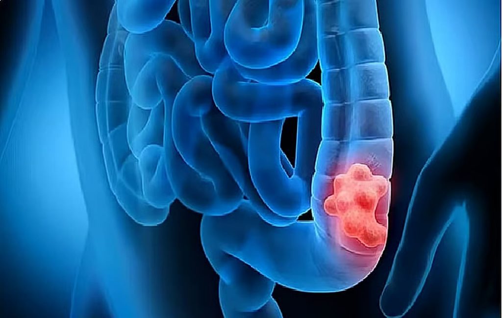 تجمع الرياض الصحي يوضح أسباب الإصابة بالقولون العصبي وطرق علاجه